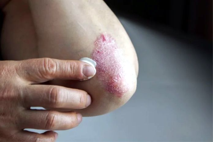 La foto atopicheskogo de la dermatitis a los nenes